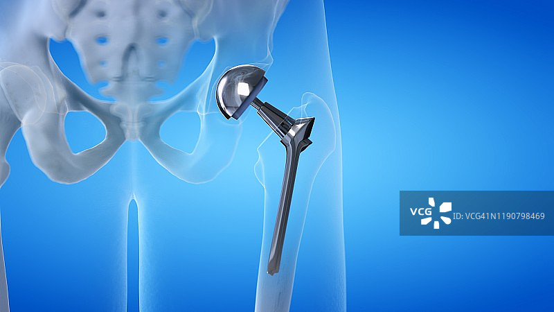 髋关节置换术插图图片素材
