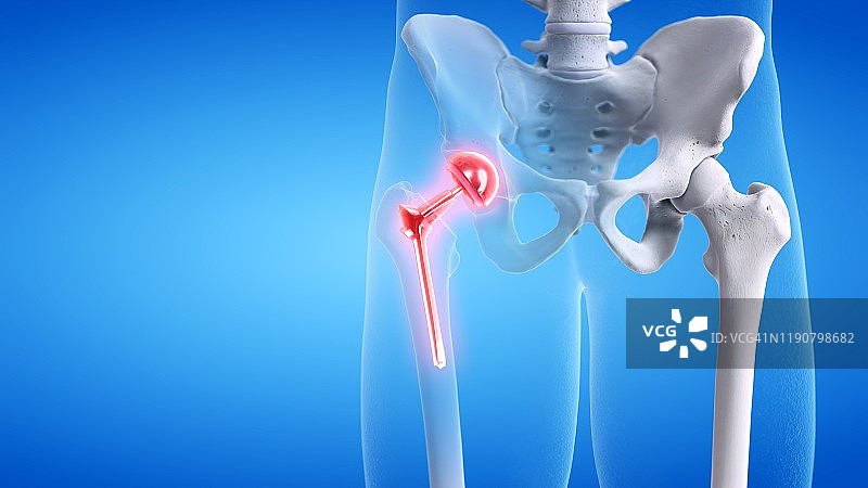 疼痛的髋关节置换概念插画图片素材