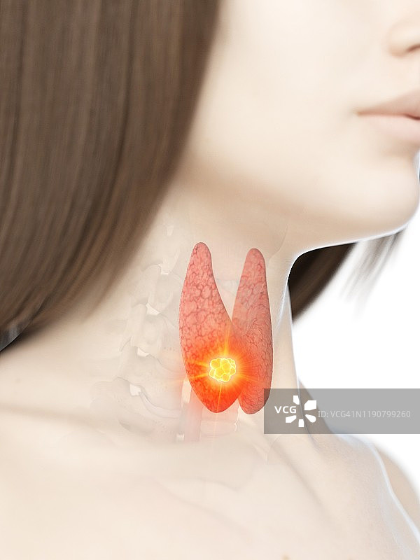 甲状腺癌概念图图片素材