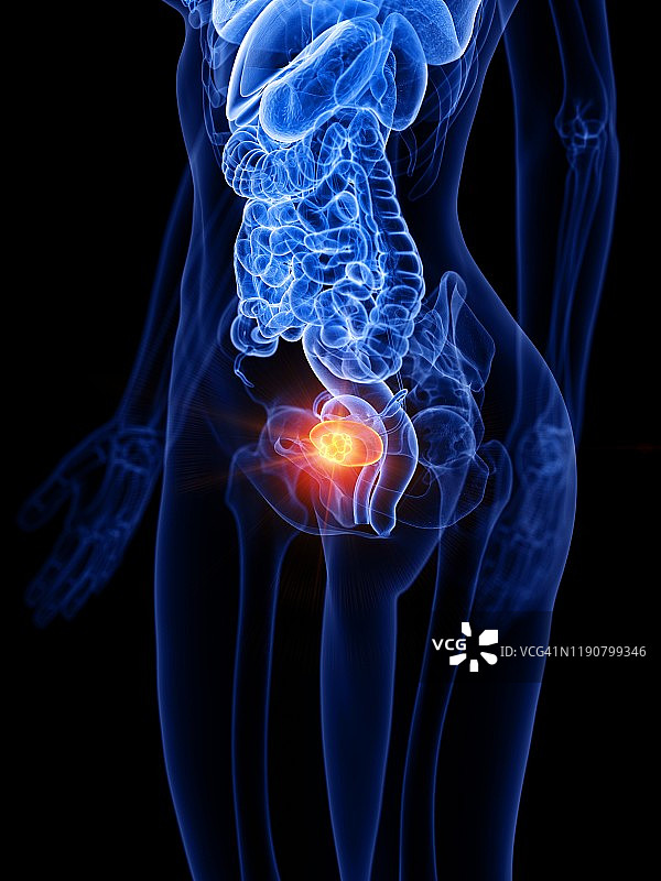 膀胱癌概念图图片素材