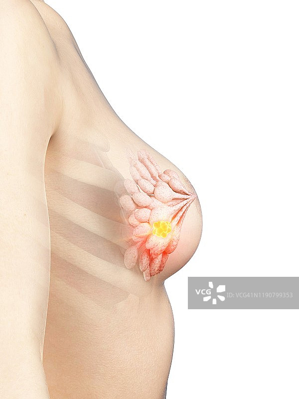 乳腺癌概念图图片素材