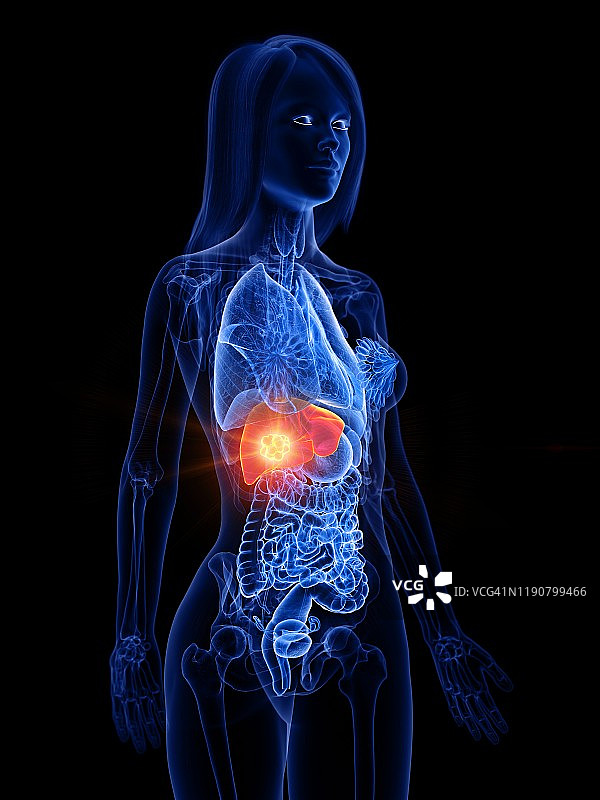 肝癌概念图图片素材