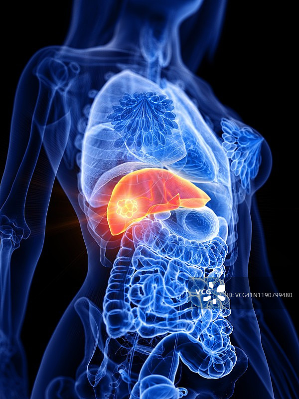 肝癌概念图图片素材
