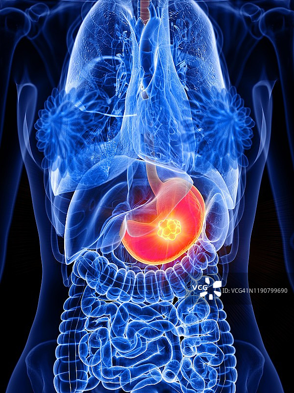 胃癌概念图图片素材