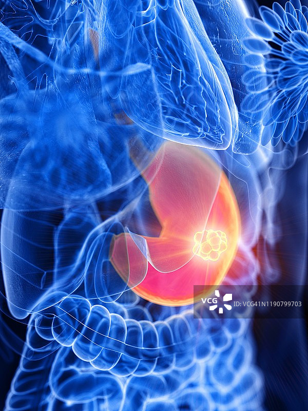 胃癌概念图图片素材