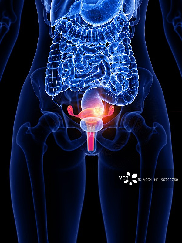 子宫癌概念图图片素材