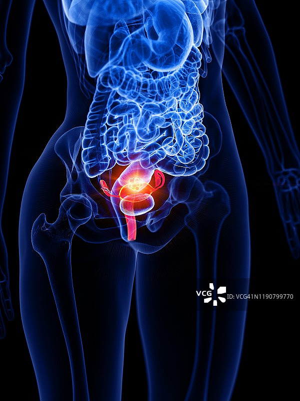 子宫癌概念图图片素材