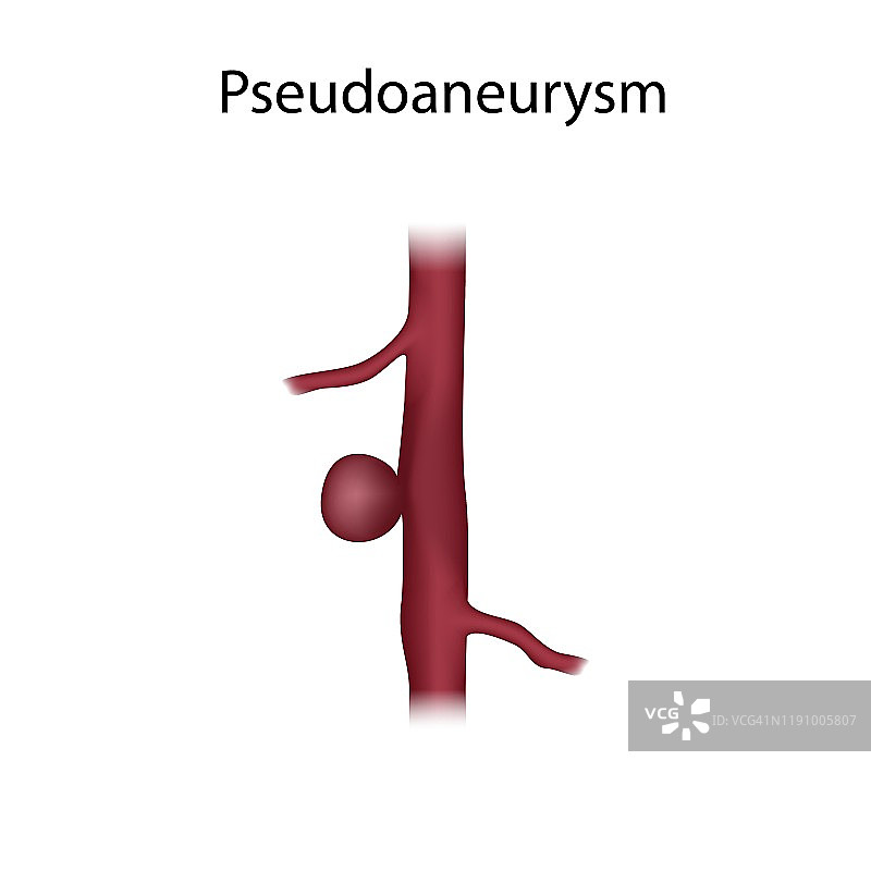 假性动脉瘤插图图片素材