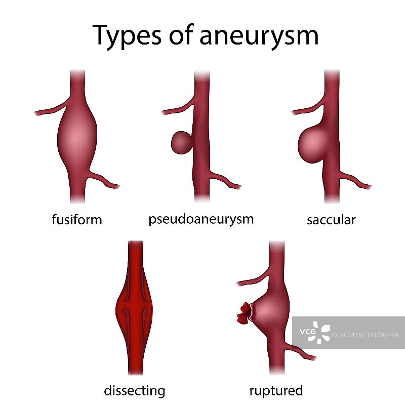 动脉瘤类型图示图片素材