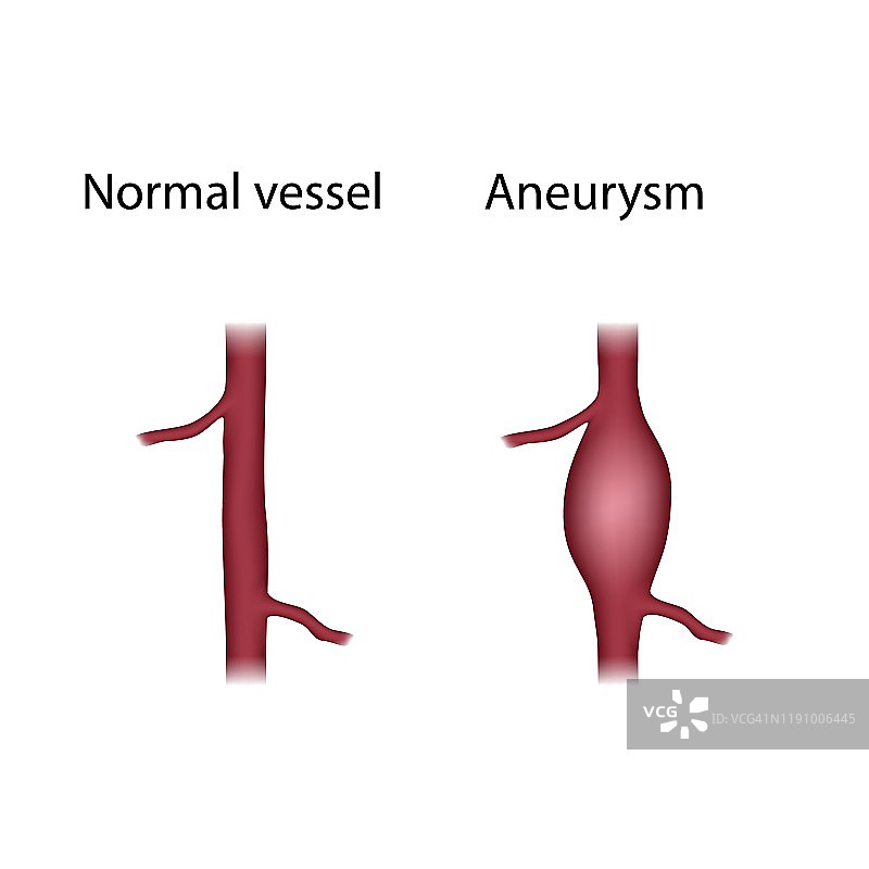 正常血管和动脉瘤，图示图片素材