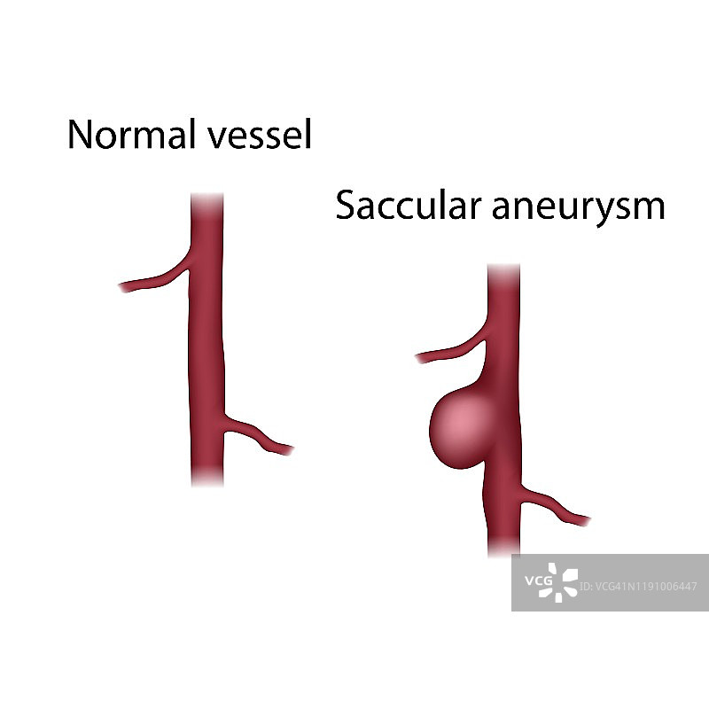 正常血管与囊状动脉瘤，图示图片素材