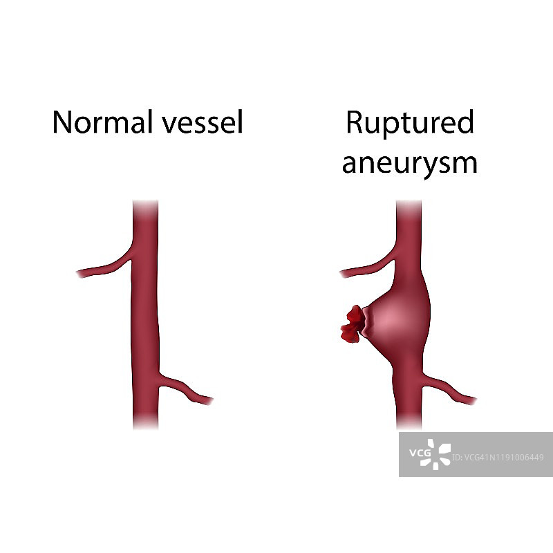 正常血管与动脉瘤破裂插图图片素材
