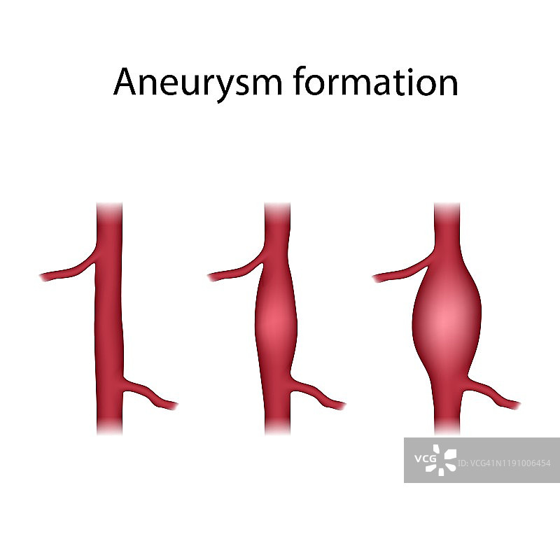 动脉瘤形成插图图片素材