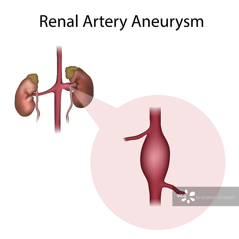肾动脉瘤插图图片素材
