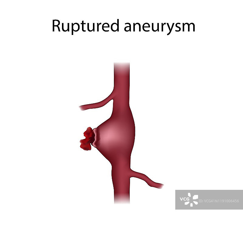 动脉瘤破裂，图示图片素材