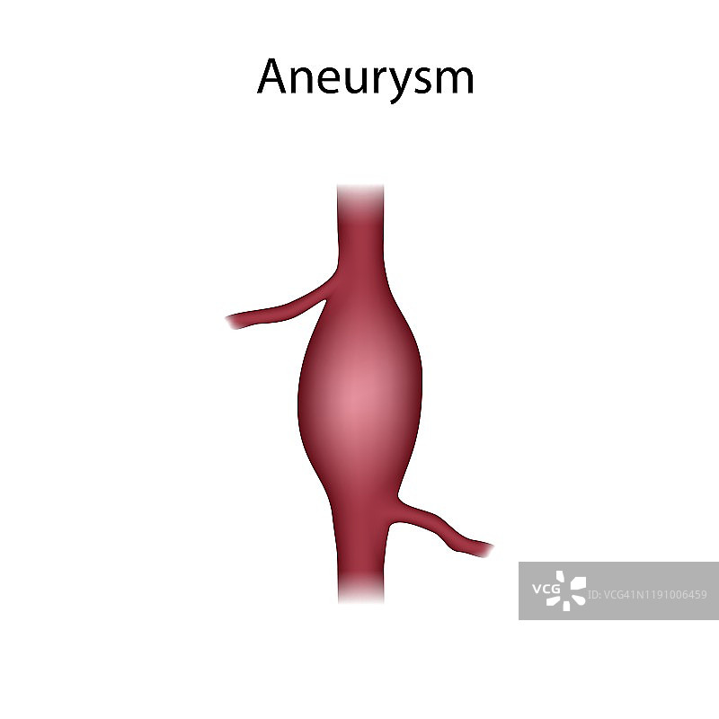 动脉瘤插图图片素材