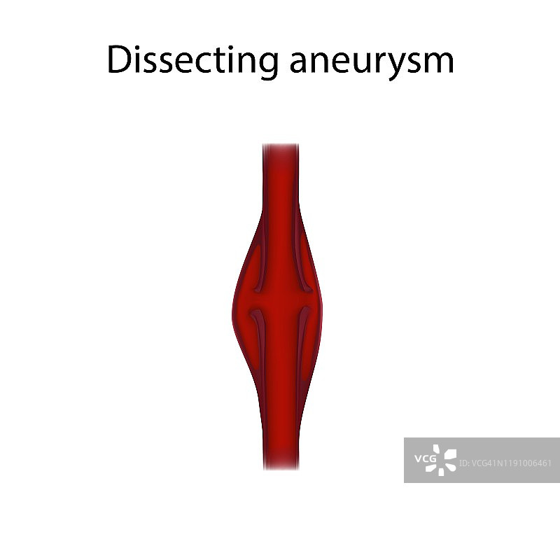 动脉瘤剥离示意图图片素材