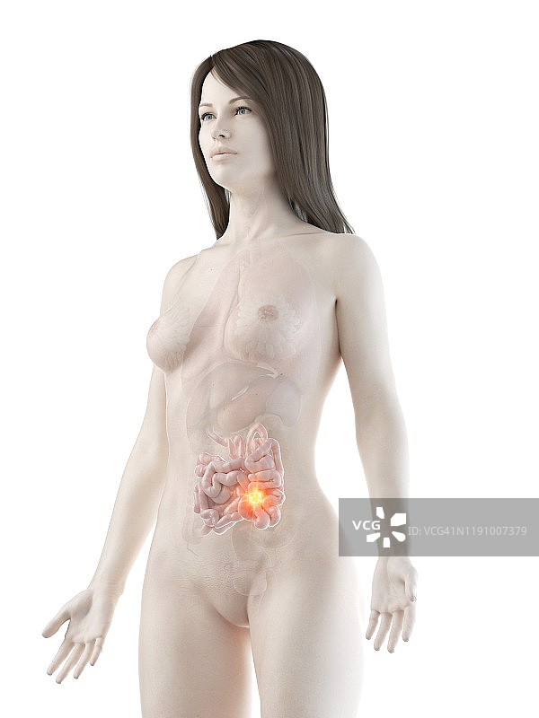 小肠癌概念计算机图解图片素材