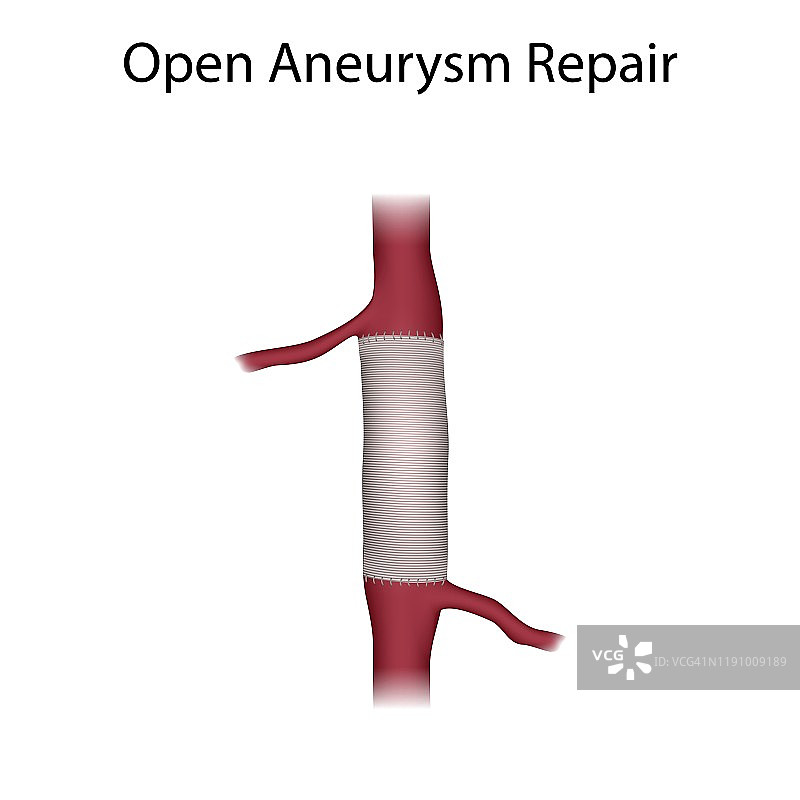 动脉瘤开放手术修复示意图图片素材