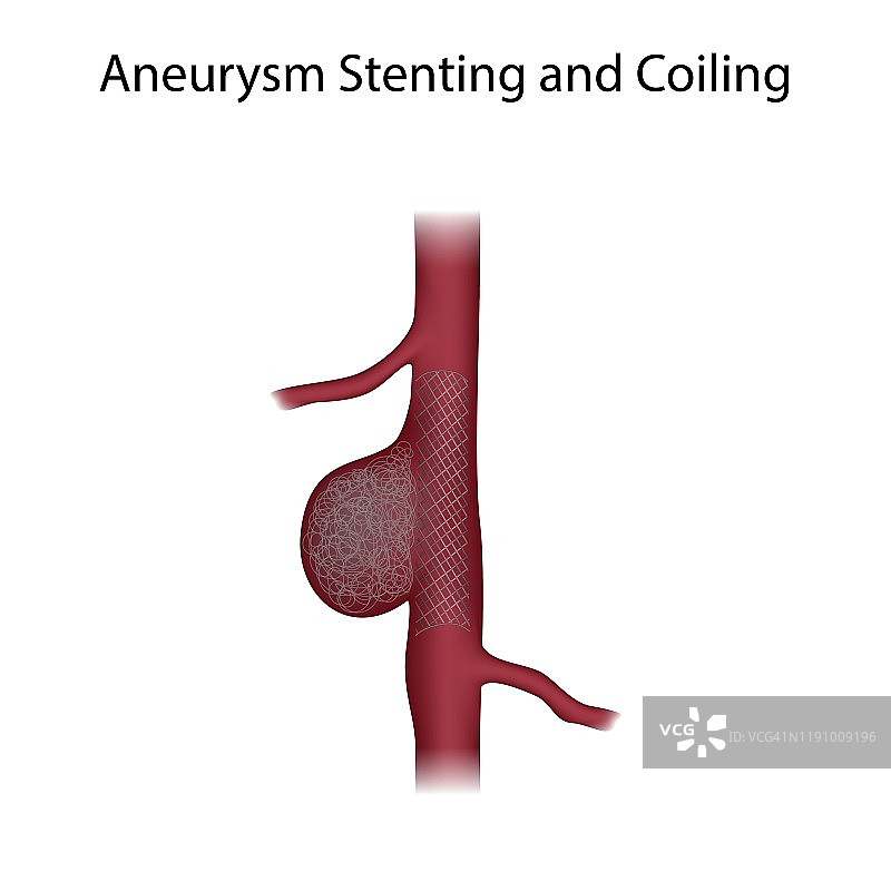 动脉瘤支架和栓塞术插图图片素材