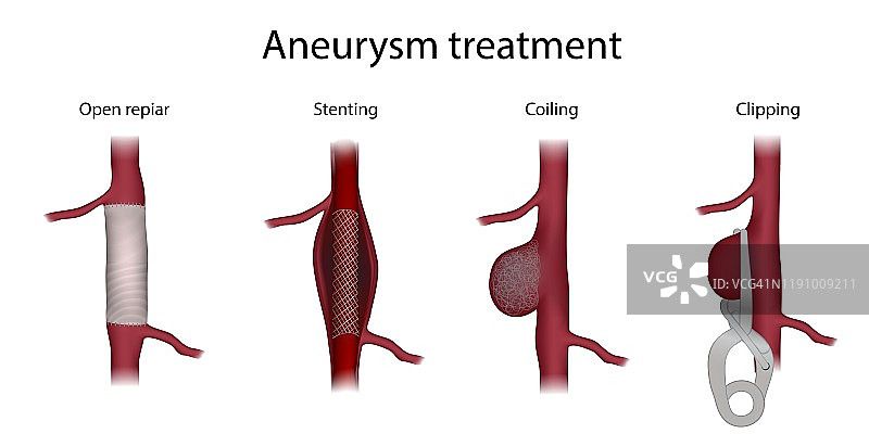 动脉瘤治疗插图图片素材