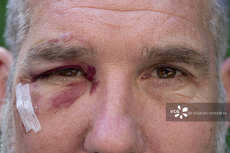 特写：眼部瘀伤的男人图片素材