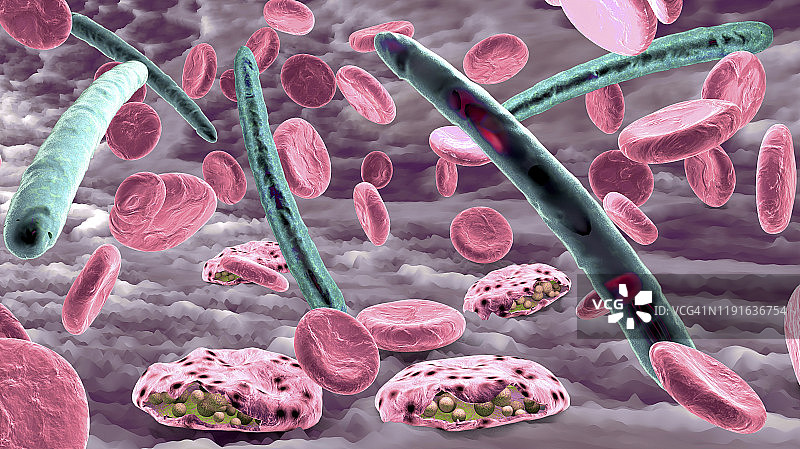 疟疾感染插图图片素材