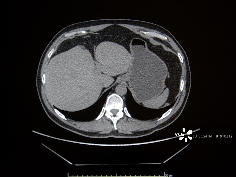腹部和骨盆的计算机轴向断层扫描（TAC）图片素材