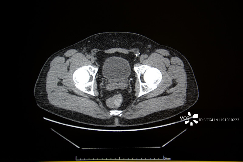 腹部和骨盆的计算机轴向断层扫描（TAC）图片素材