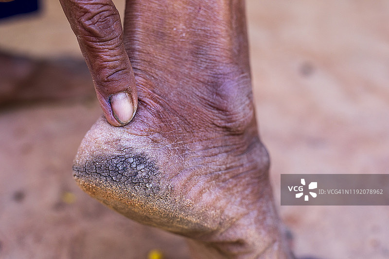 脚后跟的裂纹特写图片素材