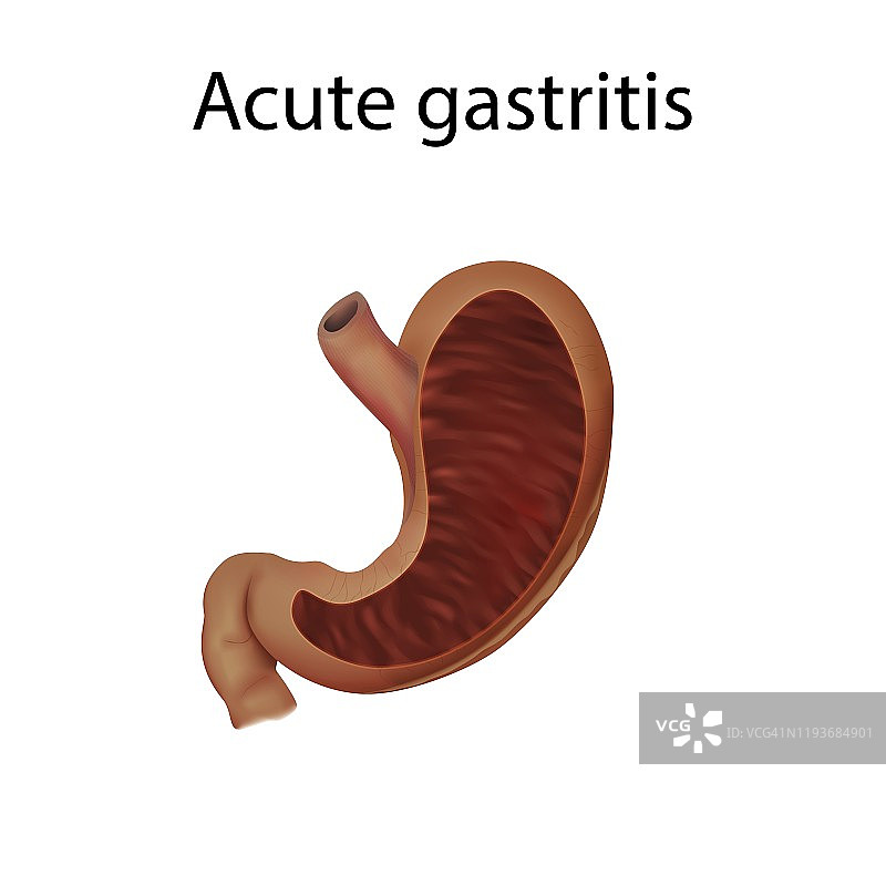 急性胃炎插图图片素材
