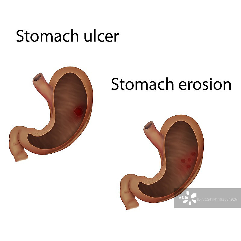 胃溃疡和胃糜烂插图图片素材