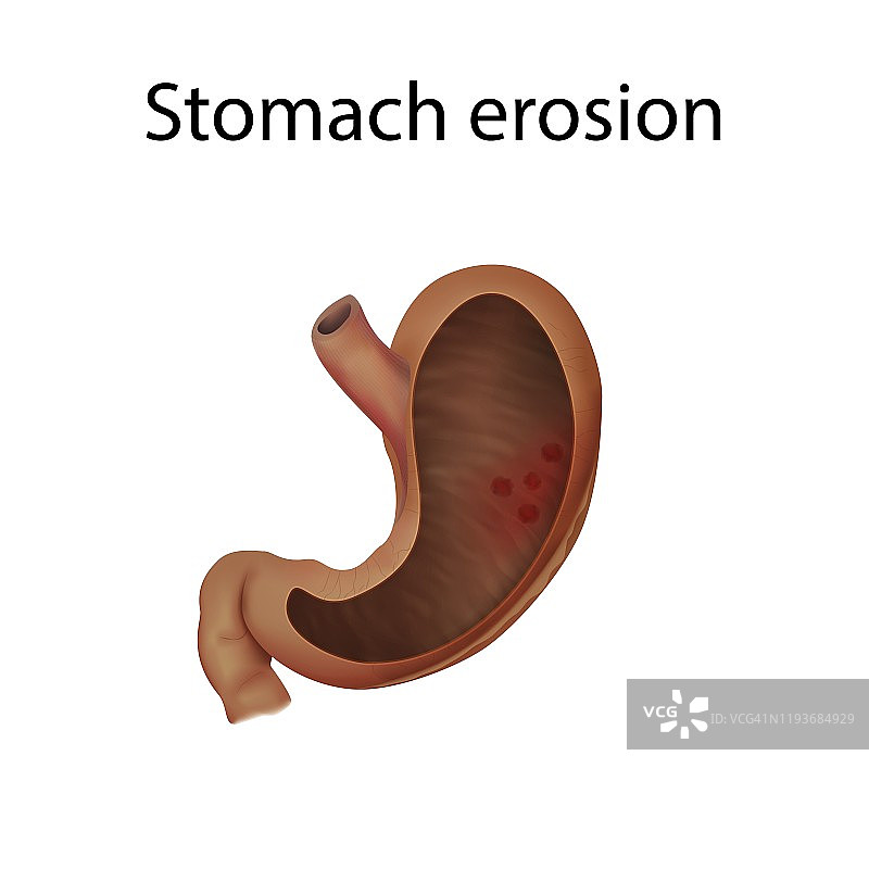 胃糜烂插图图片素材