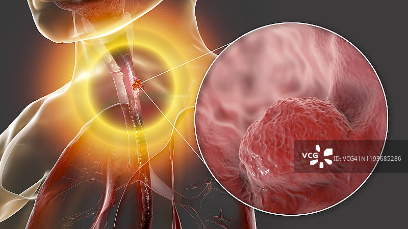 食道癌，合成插画图片素材