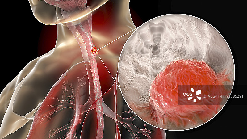 食道癌，合成插画图片素材