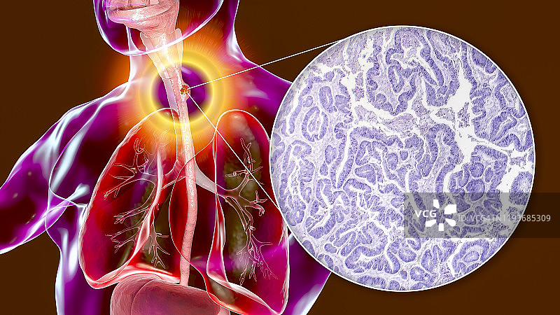 食道癌，图示和显微照片图片素材