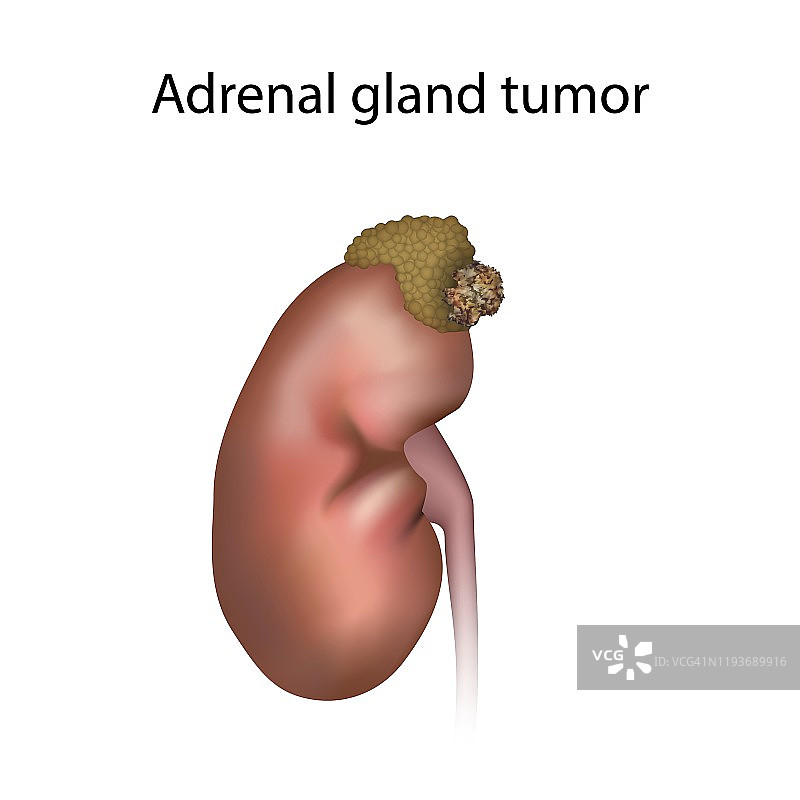 肾上腺肿瘤插图图片素材
