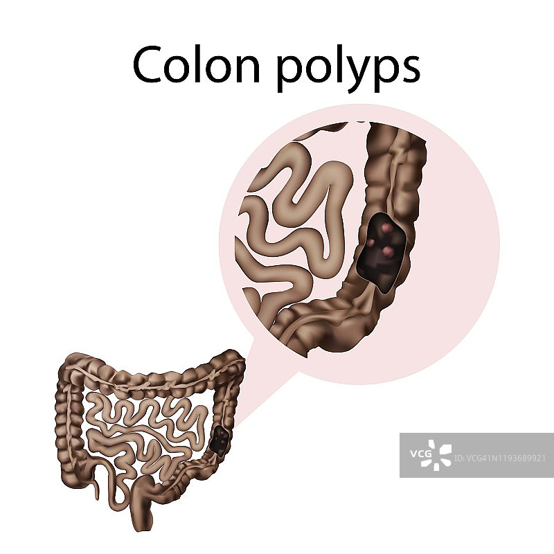结肠息肉插图图片素材