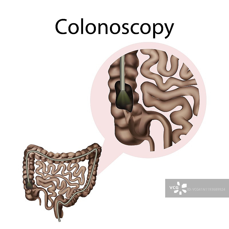 结肠镜检查插图图片素材