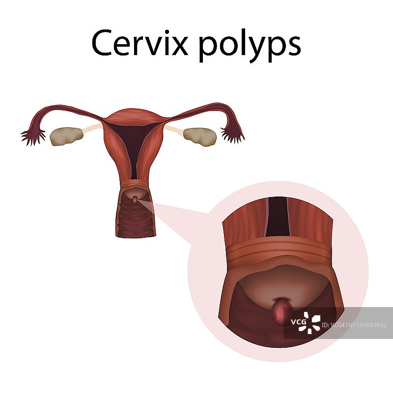 宫颈息肉插图图片素材