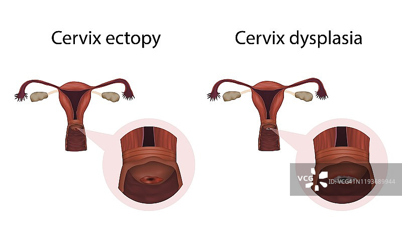 宫颈外翻和宫颈发育不良插图图片素材
