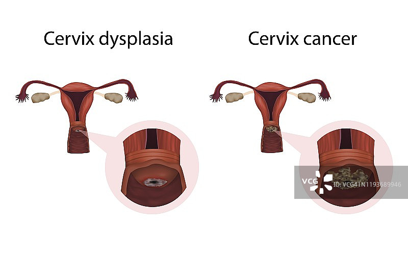 宫颈发育不良和宫颈癌插图图片素材