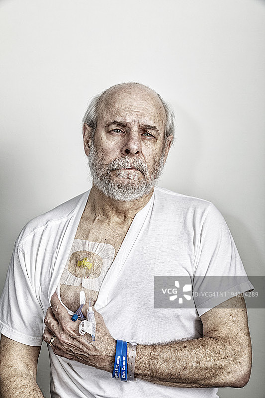 接受化疗的癌症患者展示胸部港图片素材