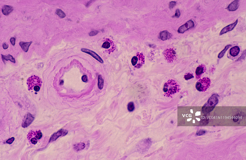 胆囊疏松结缔组织中的嗜酸性粒细胞（大量），250倍图片素材