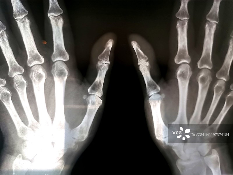 手部X光骨骼扫描图片素材