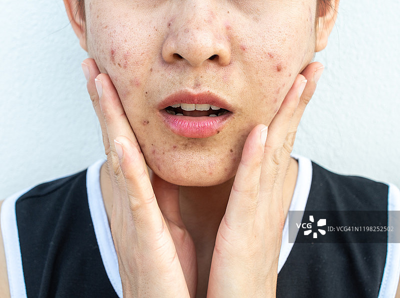 面部有痤疮炎症（丘疹和脓疱）的女人半张脸特写图片素材