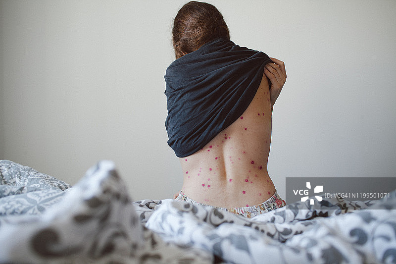 年轻女人撩起T恤，露出半个脊柱，上面布满水痘图片素材
