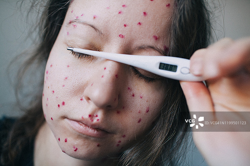 面部感染水痘、手持体温计的年轻女子肖像图片素材