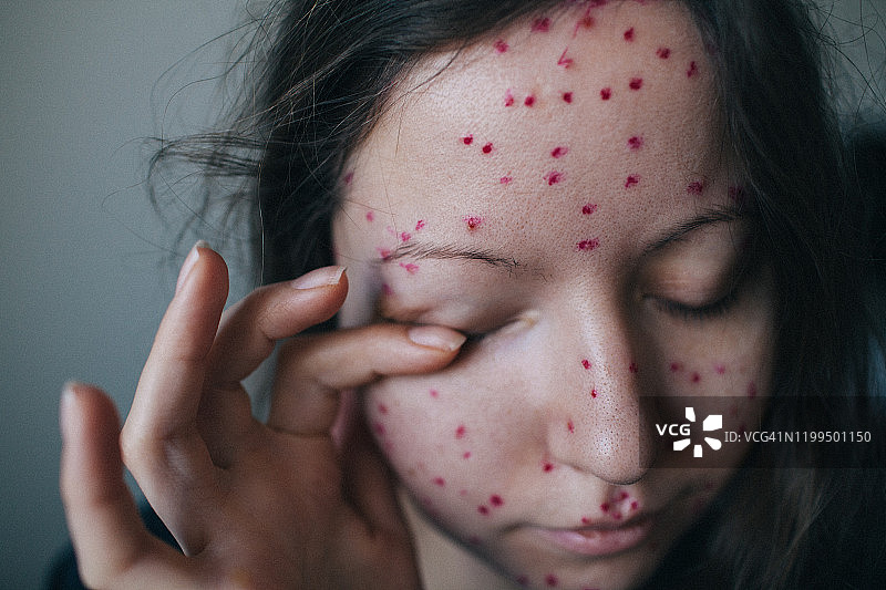 面部感染水痘的年轻女人揉眼睛的特写图片素材