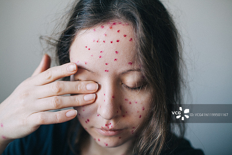 面部患有水痘的年轻女子肖像，手捂着眼睛向下看图片素材